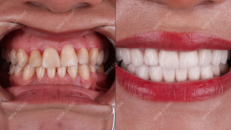 Lumineers before and after 